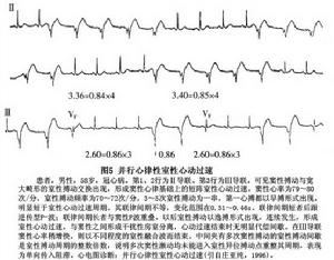 室性並行心律及室性並行心律性心動過速
