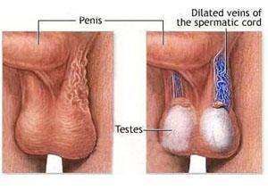 陰囊下墜 陰囊下墜