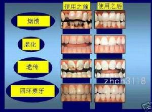 牙齒感覺過敏症
