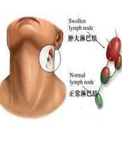何杰金氏淋巴瘤 何杰金氏淋巴瘤
