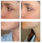 電波拉皮 電波拉皮