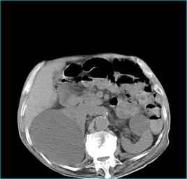 小細胞低色素貧血 小細胞低色素貧血