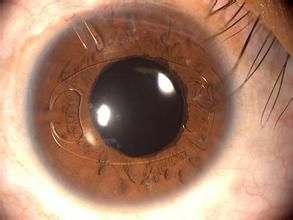 晶體溶解性青光眼 晶體溶解性青光眼