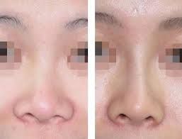 鼻翼縮小整形術