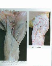 三角肌肌皮瓣手術示圖