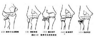 尺橈骨幹骨折