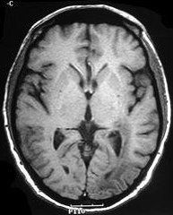 嬰兒成神經細胞瘤
