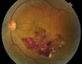 視網膜分支靜脈阻塞