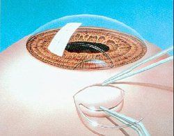 人工晶體植入術