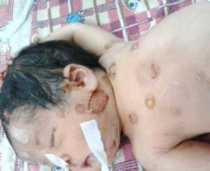 晚期先天性梅毒 晚期先天性梅毒