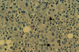 骨髓增生異常綜合徵