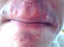 青春期時臉上的酒刺