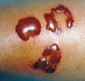 一度燙傷 一度燙傷