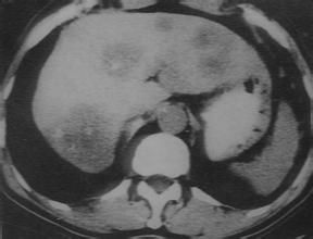 轉移性肝癌 轉移性肝癌
