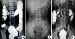 結腸造影 結腸造影
