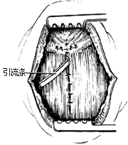 甲狀舌囊腫及瘺管