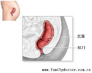 胃黏膜脫垂症