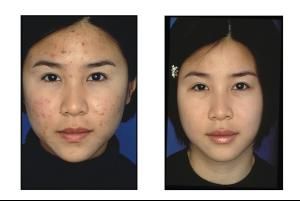 皮膚色素沉著 皮膚色素沉著