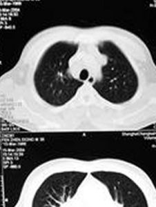 肺結節病 肺結節病
