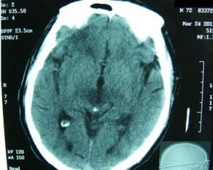 腦膜刺激征 腦膜刺激征