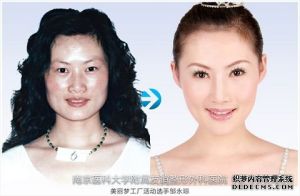 下頜角表面咬肌剝離手術效果示意圖