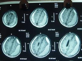 慢性硬膜下血腫 慢性硬膜下血腫