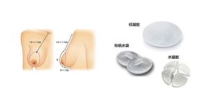 乳房假體取出術 乳房假體取出術