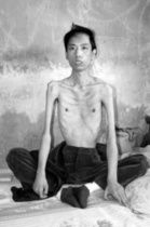 連體雙胞胎面肩胛肱型肌營養不良症 連體雙胞胎面肩胛肱型肌營養不良症