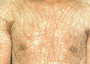 板層狀魚鱗病 板層狀魚鱗病