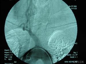 鎖骨下動脈盜血綜合徵