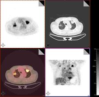 血行播散型肺結核