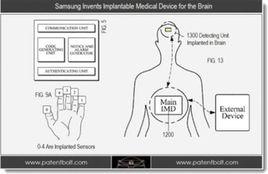 大腦植入設備 大腦植入設備