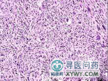 外陰惡性纖維組織細胞瘤