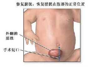 膀胱外翻 膀胱外翻