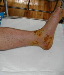 網狀淋巴管炎 網狀淋巴管炎