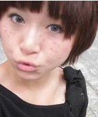 青春痘印 青春痘印