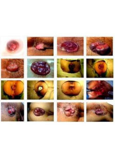 肛門墜脹 肛門墜脹