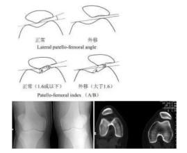 脛骨結節骨骺炎 脛骨結節骨骺炎