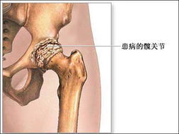 髖關節積液 髖關節積液
