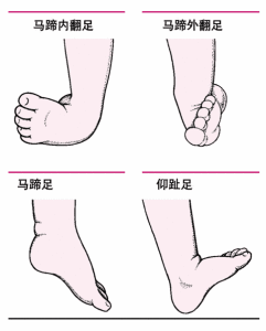 小兒脆性X染色體 小兒脆性X染色體