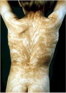 奇美拉現象[人體醫學現象]