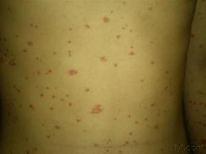 點滴型牛皮癬 點滴型牛皮癬