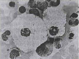 尼曼匹克氏病 尼曼匹克氏病