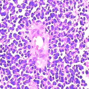 陰道血管肉瘤 陰道血管肉瘤