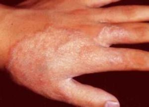 鎳及其化合物引起的皮膚病 鎳及其化合物引起的皮膚病