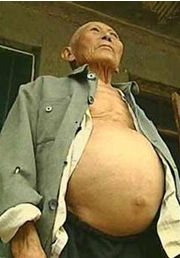 大肚子病 大肚子病