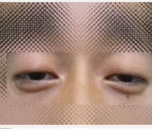 眼瞼閉合不全