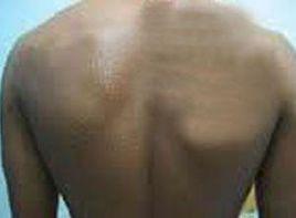 上半身熱刺激性多汗