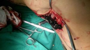 下肢靜脈曲張手術 下肢靜脈曲張手術