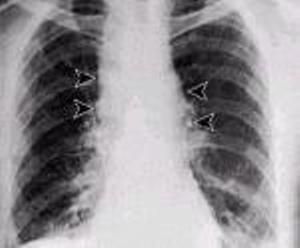 炭疽肺炎 炭疽肺炎